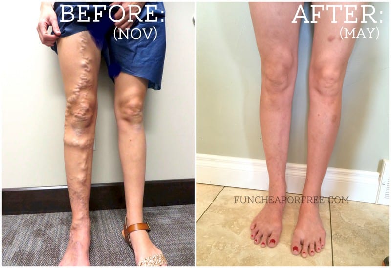 [Before] A woman's bulging varicose veins, [After] and after surgery, smooth legs from Fun Cheap Or Free