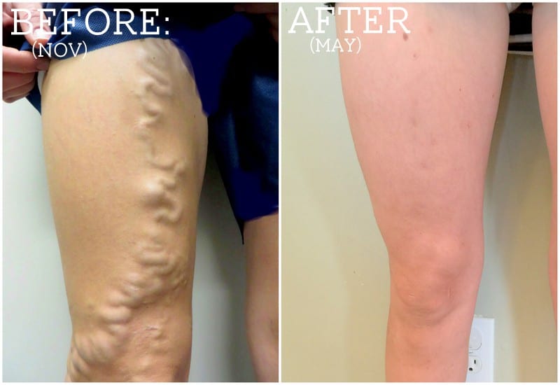 Before: Veins bulging from a woman's leg. After: Small, purple scars on a woman's smooth leg, from Fun Cheap or Free.