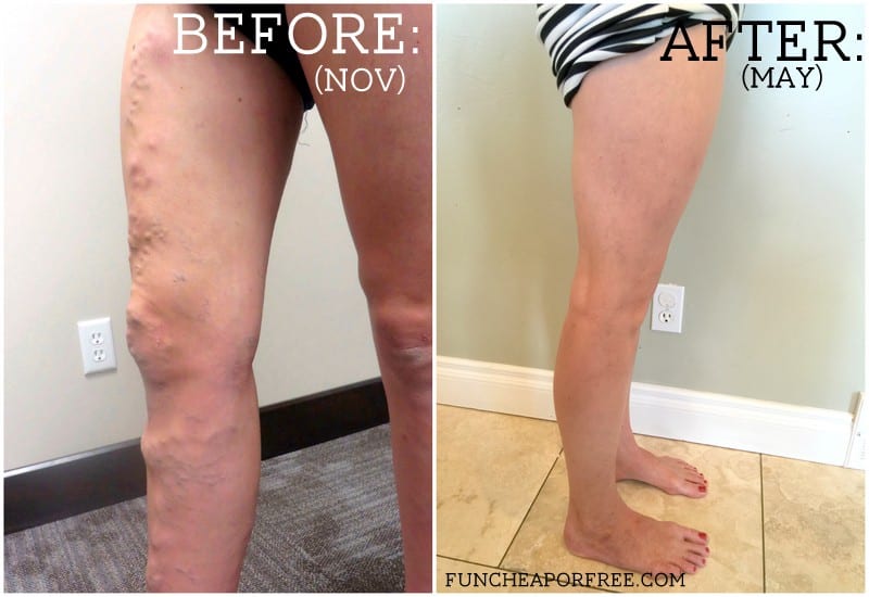 Before: A woman with bulging leg veins from the side. After: a woman's smooth legs. From Fun Cheap or Free.